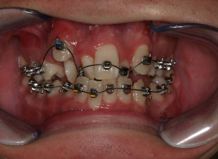 Odločite se za nevidni aparat Invisalign